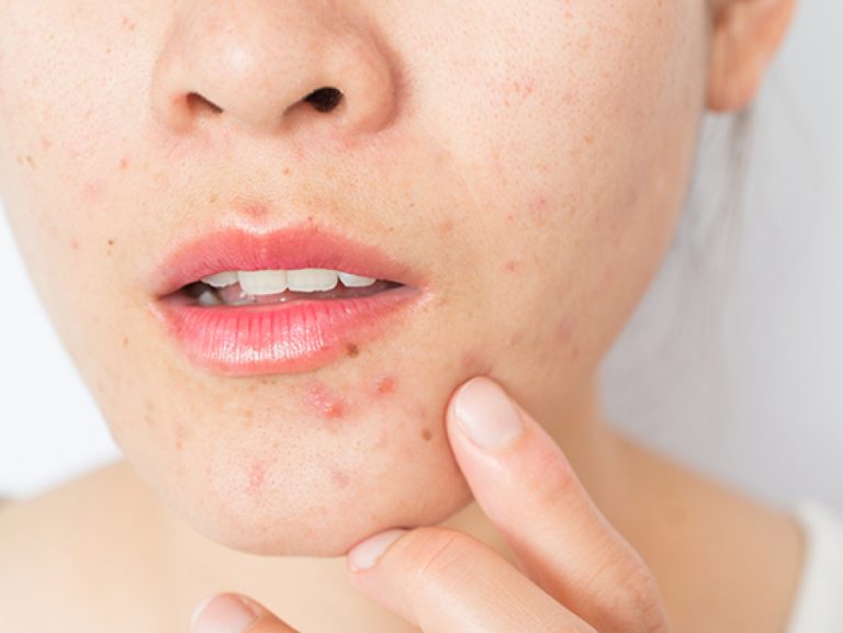 How to care for dry acne-prone skin - Okka Beauty